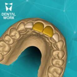 Enceramento Diagnóstico Digital - DW/INTRAOSS